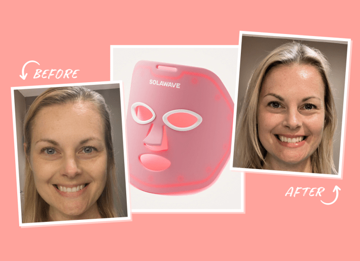 solawave wrinkle retreat mask, and how my skin looked before and after treatment